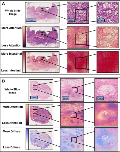 Figure showing gastric cancer samples classified by AI